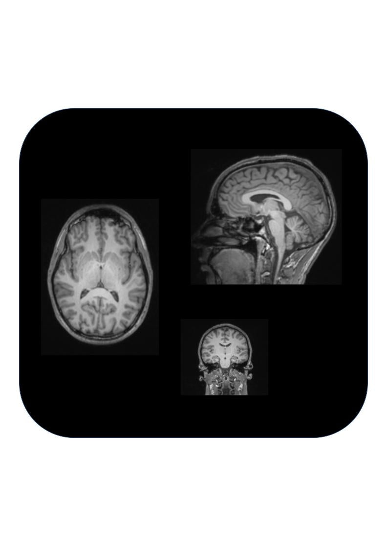 MRI Brain with and without contrast